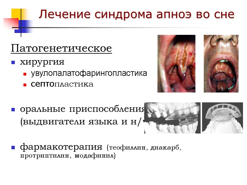 Патогенетическое хирургия увулопалатофарингопластика септопластика  оральные приспособления  (выдвигатели языка и н/ч)  фармакотерапия
